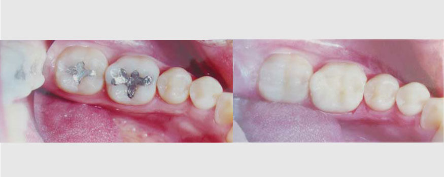 Srebrni ili bijeli zubni ispuni: Vi odlučujete