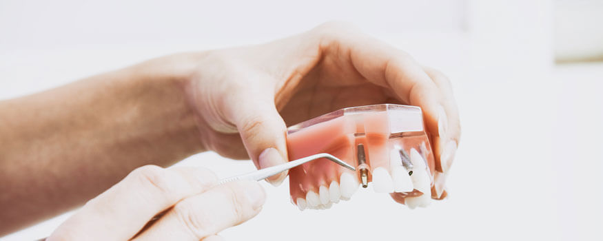 Koja je cijena zubnih implantata?