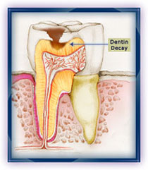 Karijes dentina