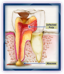 Infekcija zubne pulpe