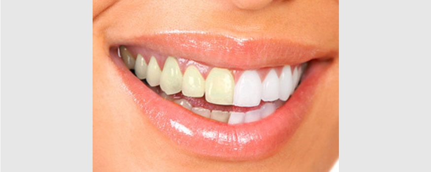 Imate li žute zube? Saznajte kako to otkloniti